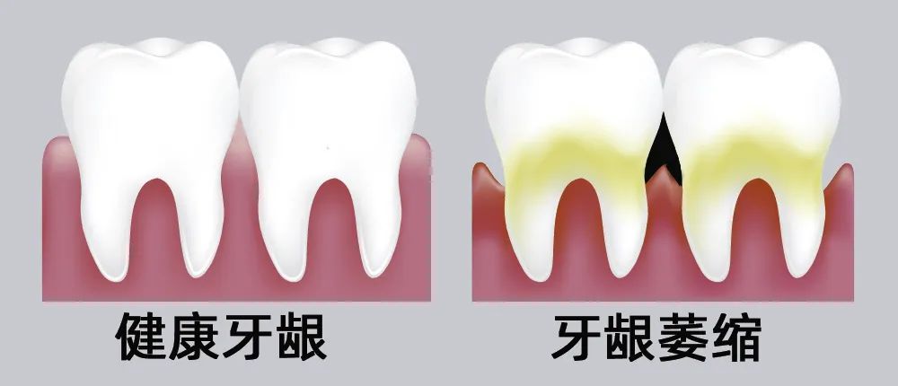 牙縫大露出“黑三角”，既塞牙又難看！還能恢復(fù)嗎？